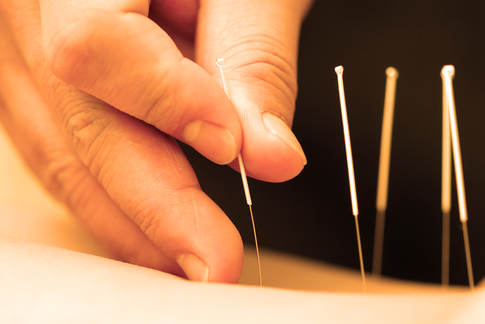 We use high quality and extremely thin and sterilized one time use acupuncture needles